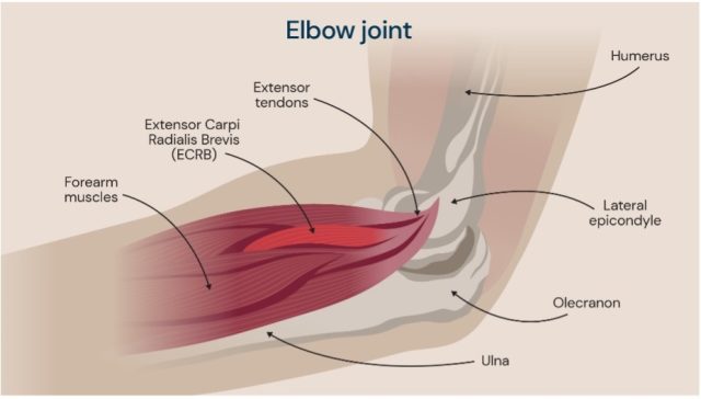 Tennis elbow